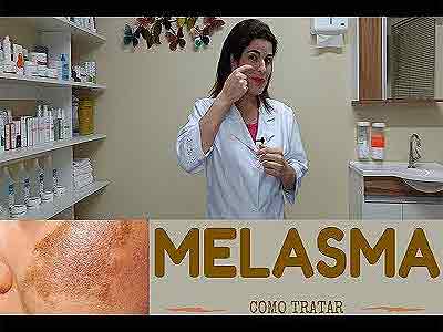 Como tratar a Melasma